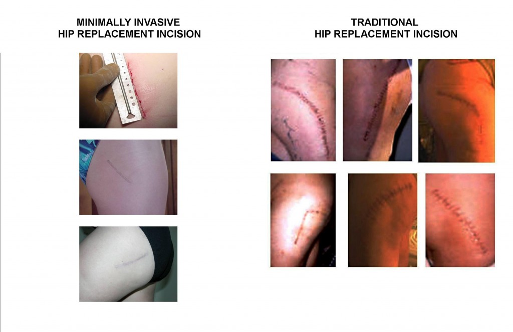 General Information For Patients Mini Total Hip